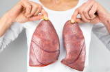 Phổi chứa đầy độc tố: 4 việc cần làm ngay nếu muốn phổi khoẻ mạnh, lọc sạch bay mọi chất độc
