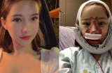 Lưu Đê Ly bất ngờ công khai quá trình phẫu thuật thẩm mỹ toàn bộ gương mặt