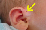 Thấy lỗ nhỏ ở vành tai kiểu này, đến gặp bác sĩ ngay vì căn bệnh nguy hiểm đang đứng ngay bên cạnh