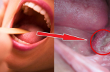 5 cảnh báo vấn đề sức khỏe ở vùng răng miệng nhất định không được bỏ qua, nhất là số 1