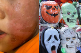 Bé trai 4 tuổi bỏng rộp da mặt sau khi đeo mặt nạ siêu nhân Halloween: Chuyên gia da liễu cảnh báo điều này