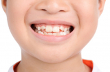 Những thói quen tai hại khiến răng trẻ mọc lệch: Điều cuối cùng là dễ mắc phải nhất