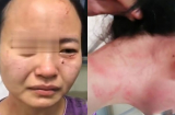 Nữ y tá bị bệnh nhân nhiễm Covid-19 đánh đập, cắn rách mặt