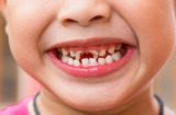 5 món ăn vặt hấp dẫn nhưng nằm trong danh sách 'đen', ảnh hưởng đến men răng của trẻ