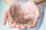 Rụng nhiều tóc là dấu hiệu của bệnh gì?