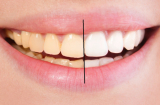 Chuyên gia mách bạn bí quyết giúp răng luôn trắng sáng tự nhiên như đi nha sĩ
