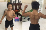 Cậu bé 10 tuổi cơ bắp cuồn cuộn dù không hề tập luyện do mắc hội chứng hiếm gặp