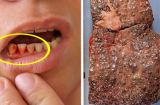 4 dấu hiệu trên miệng cảnh báo gan bị tổn thương nghiêm trọng, số 3 ai cũng bị nên dễ chủ quan