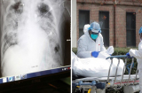 Vừa cảm tạ vì được ghép phổi, người phụ nữ qua đời sau 3 ngày: Phổi người hiến nhiễm virus nCoV
