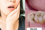 10 cách giảm đau khi mọc răng khôn hiệu quả tại nhà