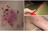 Rệp giường lọt top côn trùng nguy hiểm nhất TG, gây nhiễm trùng máu: Giặt chiếu không hết, phải khéo trị bằng cách khác