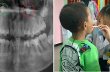 Con 8 tuổi vẫn không thay chiếc răng nào, Bs mắng mẹ: Cứ ở nhà thì không có răng vĩnh viễn luôn