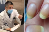 Nhiều người bị tiểu đường mà không biết: Bác sĩ mách cách nhìn vào móng tay để tự phát hiện