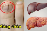 4 dấu hiệu ở bàn chân cảnh báo chức năng gan suy giảm, có thể ra đi bất cứ lúc nào nếu chủ quan