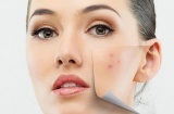 Làn da có thể bị phá hủy và tổn thương vì loạt thói quen thường thấy sau