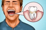 4 dấu hiệu cho thấy bạn đang đánh răng sai cách, làm hỏng răng lợi