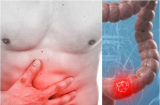 6 dấu hiệu cảnh báo bệnh đường ruột của bạn đang bệnh nặng, chỉ cần có 1 cũng nên đi khám