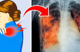 Tự kiểm tra sức khỏe của phổi thông qua 6 dấu hiệu: Xuất hiện 1 điểm cũng đáng lo ngại, cần điều trị gấp