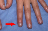 6 triệu chứng trên ngón tay cảnh báo có bệnh trong người: Cẩn thận gan và phổi đang kêu cứu