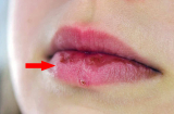 5 dấu hiệu ở miệng cho thấy gan đang bị tổn thương, có nhiều hơn 1 cẩn thận gan nát bấy