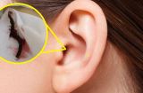 Rết dài 5 cm 'làm tổ' trong tai người phụ nữ, bác sĩ nhìn cũng thấy 'hết hồn'