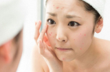 6 vấn đề da hay gặp vào mùa đông, bạn cần chú ý để chăm sóc da tốt nhất