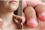 10 dấu hiệu cảnh báo cơ thể có bệnh, thiếu chất trầm trọng: Đốm trắng trên móng tay, nhiệt miệng, rụng tóc...