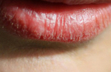 Người có gan xấu thường có 4 biểu hiện trên môi, 'dính' trên 2 cái là cần đi viện gấp