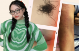 Phương Mỹ Chi hé lộ loạt ảnh tay chân bầm tím, rụng tóc nghiêm trọng ở tuổi 18