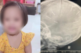 Tình hình sức khỏe của bé gái 3 tuổi ở Hà Nội hiện giờ ra sao?