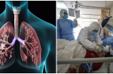 2 di chứng nặng nề nhất ở phổi mà F0 có thể gặp: Phổi trắng tinh nếu phát hiện muộn