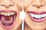 7 cách đơn giản giúp loại bỏ cao răng tại nhà mà không hề tốn kém