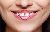 Cái răng cái tóc là góc con người: 5 kiểu răng xấu phá tướng, chặn đứng tài lộc