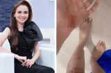 Hoa hậu Diễm Hương gây lo lắng khi chia sẻ loạt ảnh trầy da rướm máu khi bị tai nạn giao thông