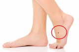 3 nốt ruồi ở lòng bàn chân tượng trưng cho Tài - Lộc  - Danh ai có 1/3 cũng viên mãn trọn đời