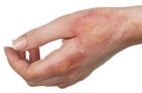 5 mẹo chữa sẹo bỏng tại nhà giúp là phẳng làn da sần sùi chỉ trong thời gian ngắn