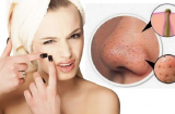 6 điều cần chú ý khi trị mụn đầu đen tránh làm tổn thương da mặt