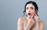 5 nguyên tắc chăm sóc da sau khi nặn mụn bạn cần 'khắc cốt ghi tâm'