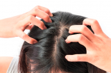 5 công thức làm sạch da đầu giảm tình trạng gàu rụng lả tả, tóc bết dầu