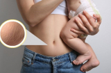6 mẹo khắc phục tình trạng rạn da sau sinh giúp chị em lấy lại vẻ căng mịn cho làn da