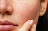 Chuyên gia bật mí loạt tips tránh bít tắc lỗ chân lông vùng mũi để da luôn sạch và thông thoáng