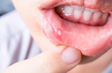 9 cách chữa nhiệt miệng tại nhà hiệu quả, không cần dùng đến thuốc