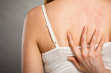 8 điều cần lưu ý khi trị mụn lưng giúp nàng có được tấm lưng trắng ngần