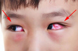Đau mắt đỏ đang hoành hành, vậy nhìn vào mắt người bệnh có bị lây không?