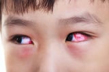 Bị đau mắt đỏ kiêng ăn gì?