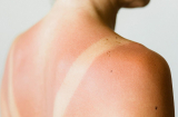 Các cấp độ da cháy nắng và thời gian phục hồi an toàn cho làn da bạn nên biết