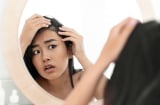 5 cách trị rụng tóc, hói đầu giúp mái tóc bồng bềnh như suối mây