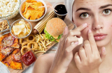 3 loại đồ ăn ăn càng nhiều mặt càng nổi mụn, nàng nên chú ý để loại bỏ khỏi thực đơn