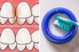 5 cách  lấy cao răng siêu đơn giản tại nhà, không tốn xu nào