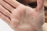 Ai sở hữu 3 nốt ruồi trên bàn tay này báo hiệu điềm lành, nhiều phúc khí cao sang, viên mãn